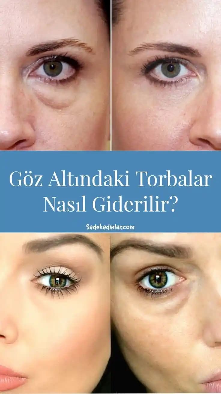 Göz Altı Morlukları ve Torbalarını Gidermenin Etkili Yöntemleri ve Uzman Tavsiyeleri