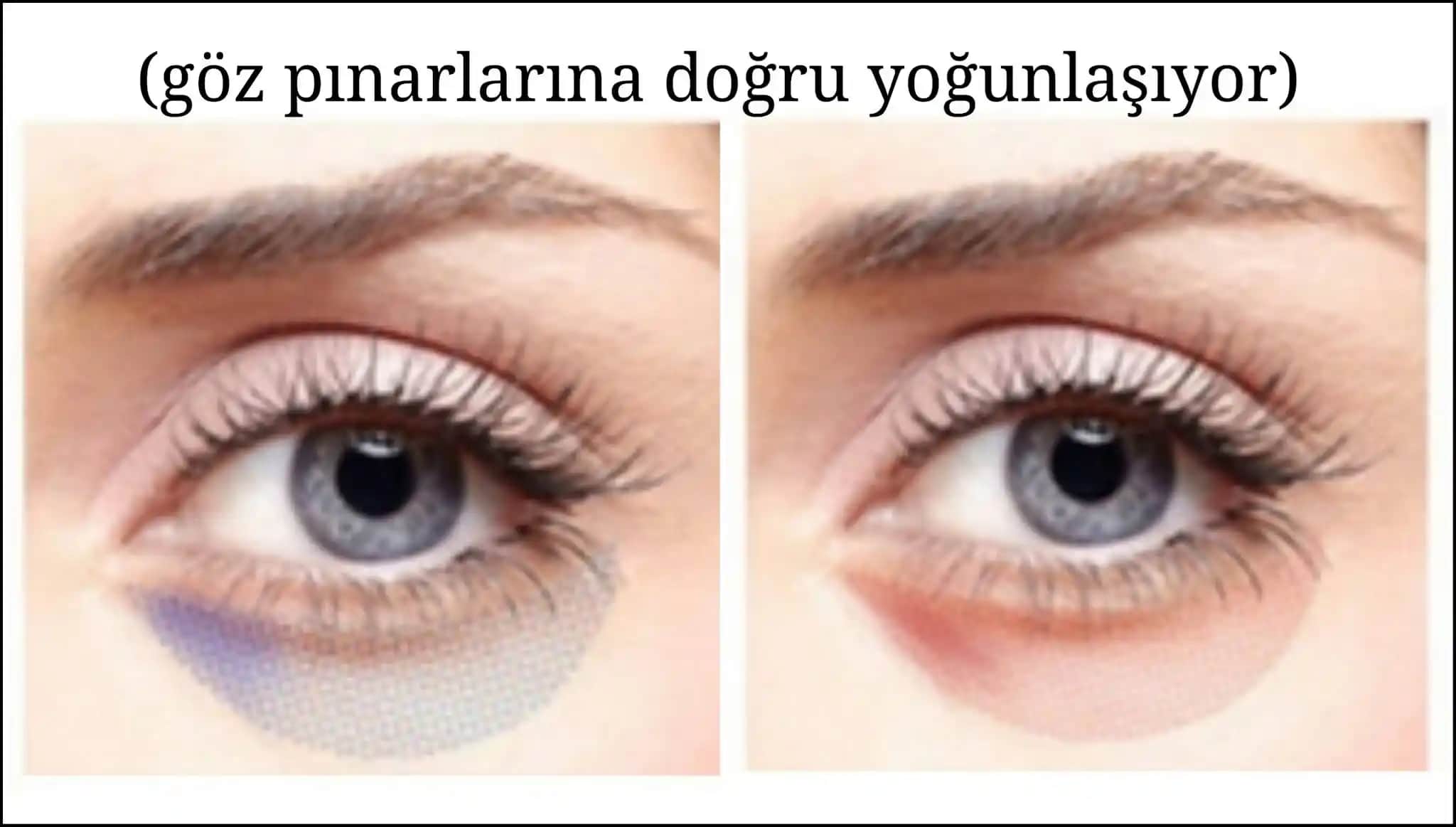 Göz Altı Morluklarının Tipleri, Nedenleri ve Uygun Çözüm Yöntemleri