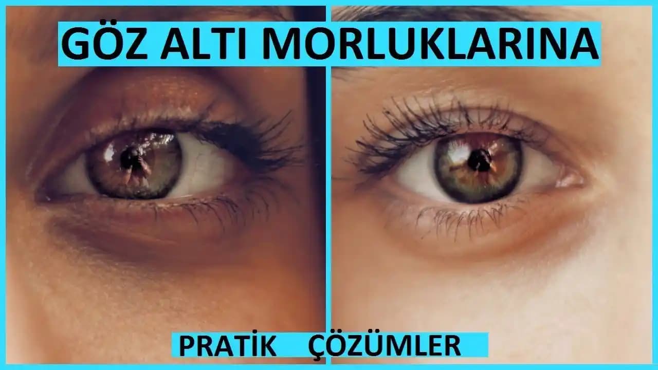 Göz Altı Morluklarıyla Mücadelede Bilmeniz Gereken Etkili Yöntemler ve İpuçları