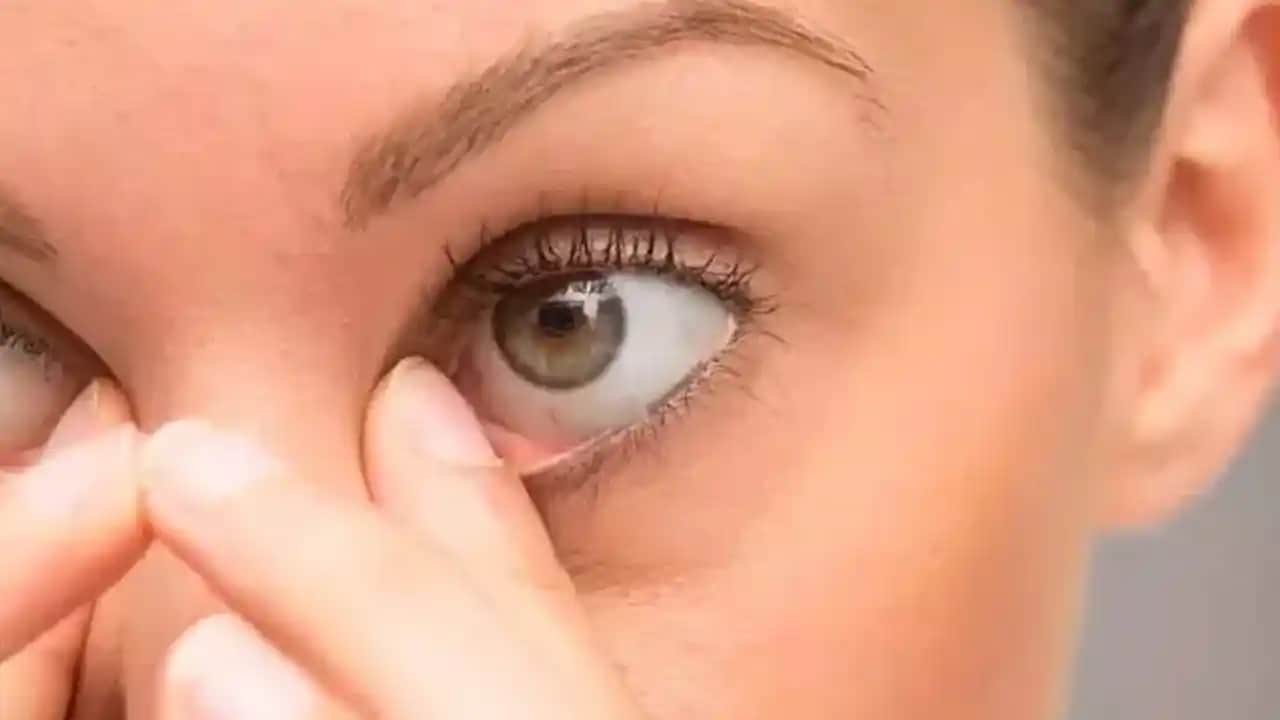 Göz Altı Siyahlığına Karşı Etkili Yöntemler ve Doğal Çözüm Tavsiyeleri