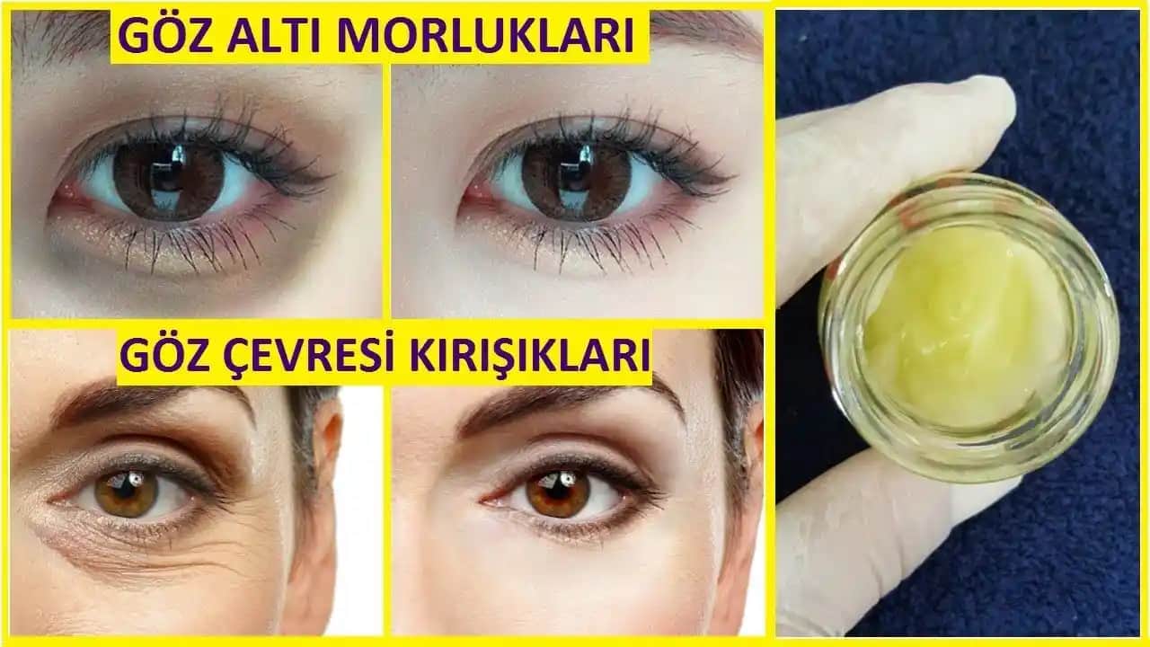 Göz Çevresi Morluklarını Azaltmak ve Göz Sağlığını Koruma Yöntemleri
