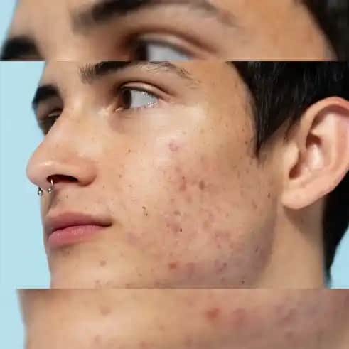 Göz Çevresinde Sivilce Nedenleri ve Etkili Çözüm Yolları