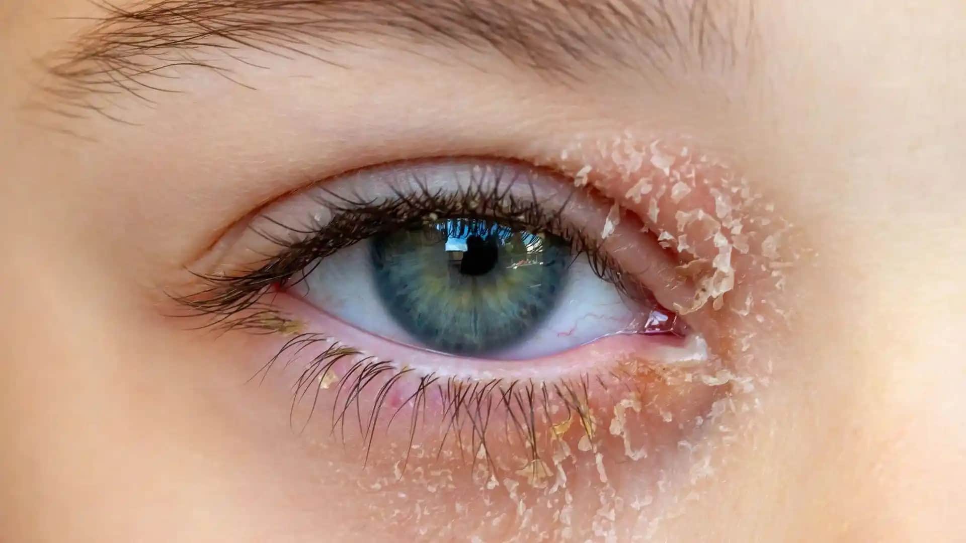 Göz Egzaması Nedir, Belirtileri ve Tedavi Yöntemleri Hakkında Detaylı Bilgi