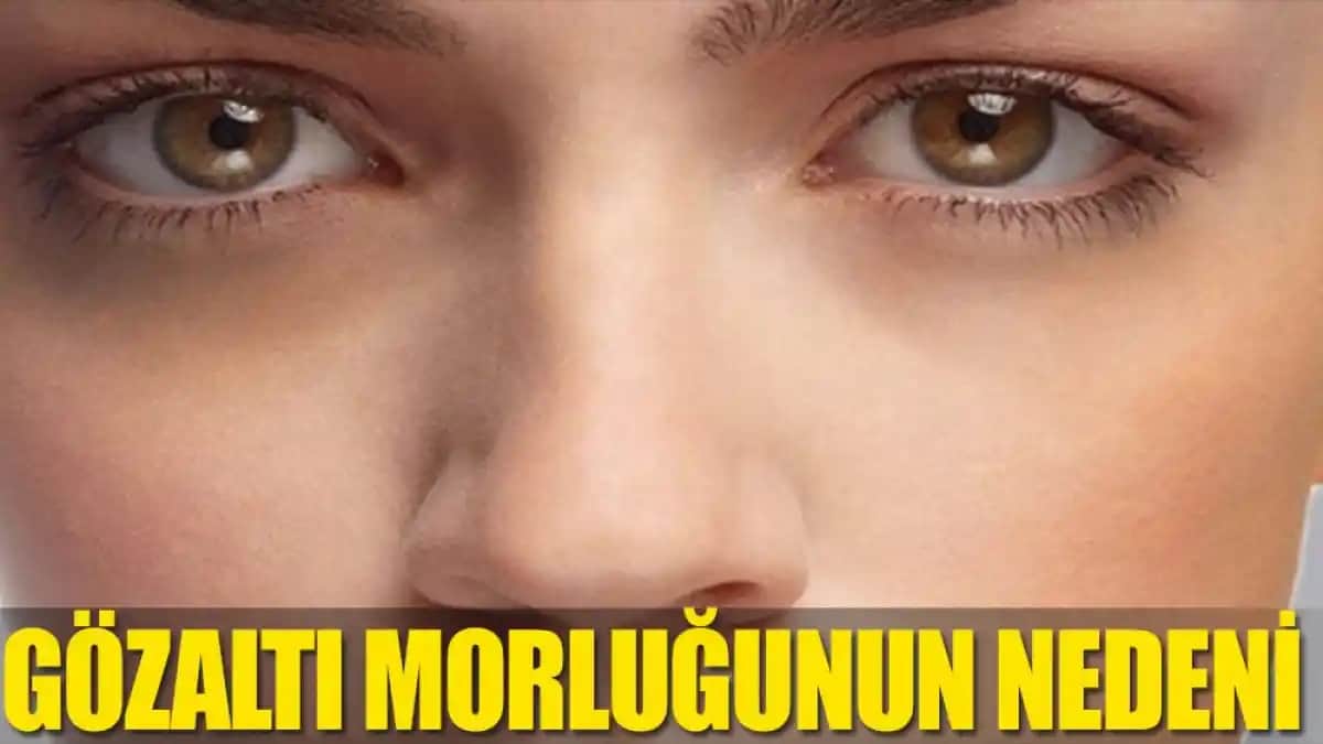 Göz Etrafı Morarmalarının Nedenleri ve Etkili Çözüm Yöntemleri
