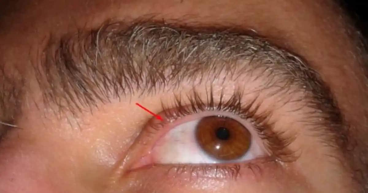 Göz İçi Sivilcelerinin Nedenleri, Belirtileri ve Etkili Çözüm Yöntemleri