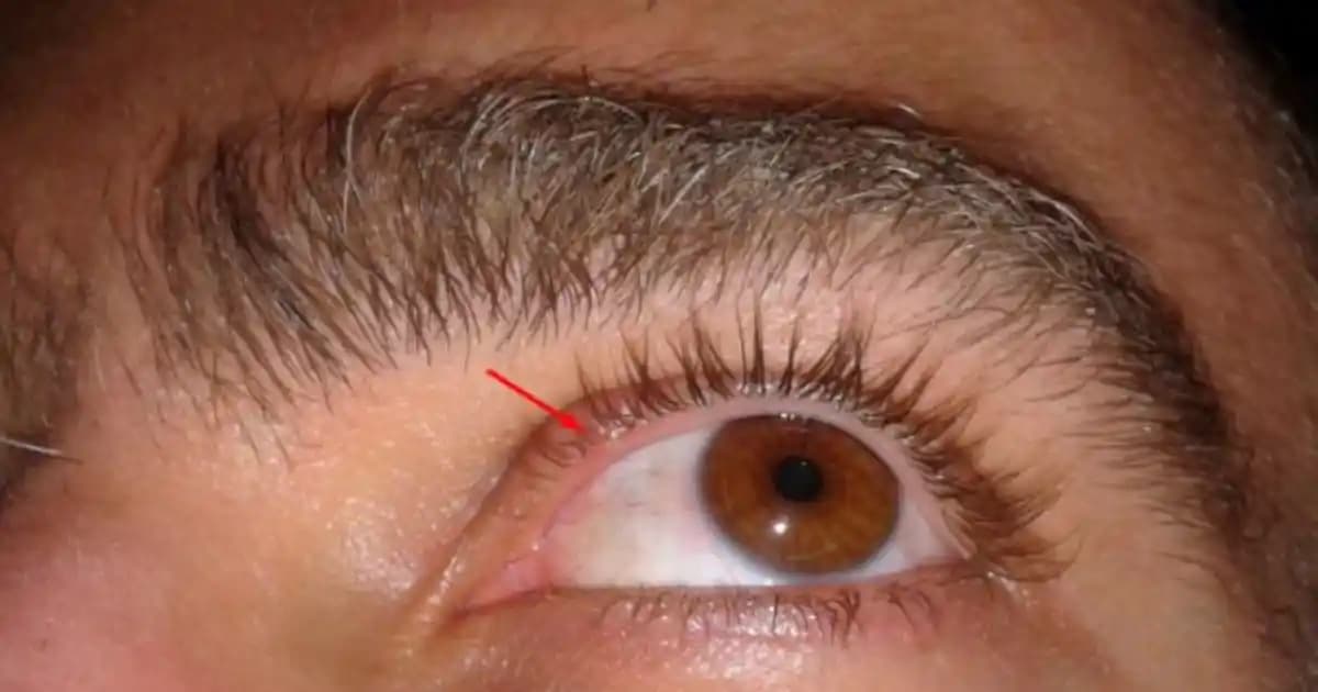 Göz İçi Sivilcelerinin Nedenleri, Belirtileri ve Etkili Çözüm Yöntemleri