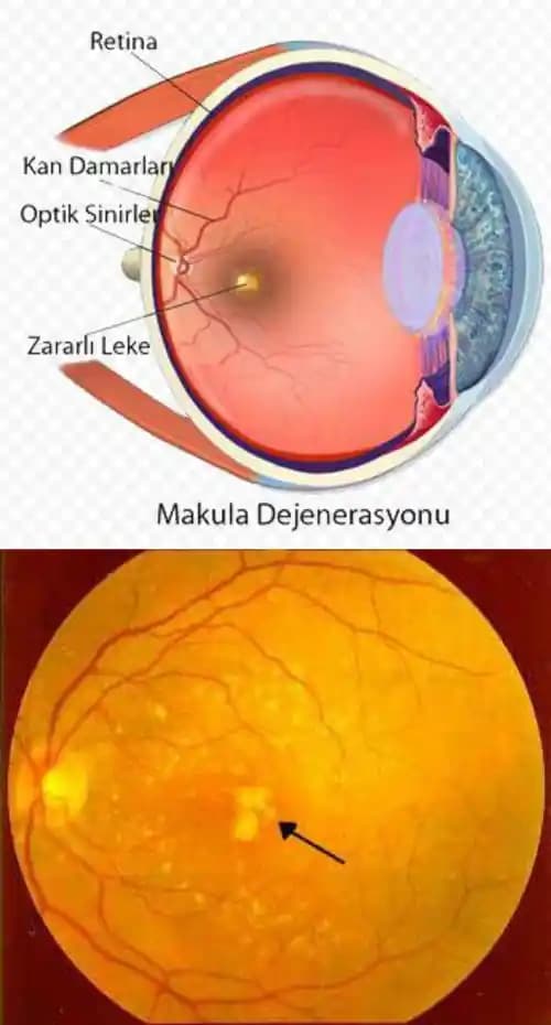 Göz İçinde Sarı Leke Nedenleri ve Tedavi Seçenekleri Hakkında Detaylı Bilgi