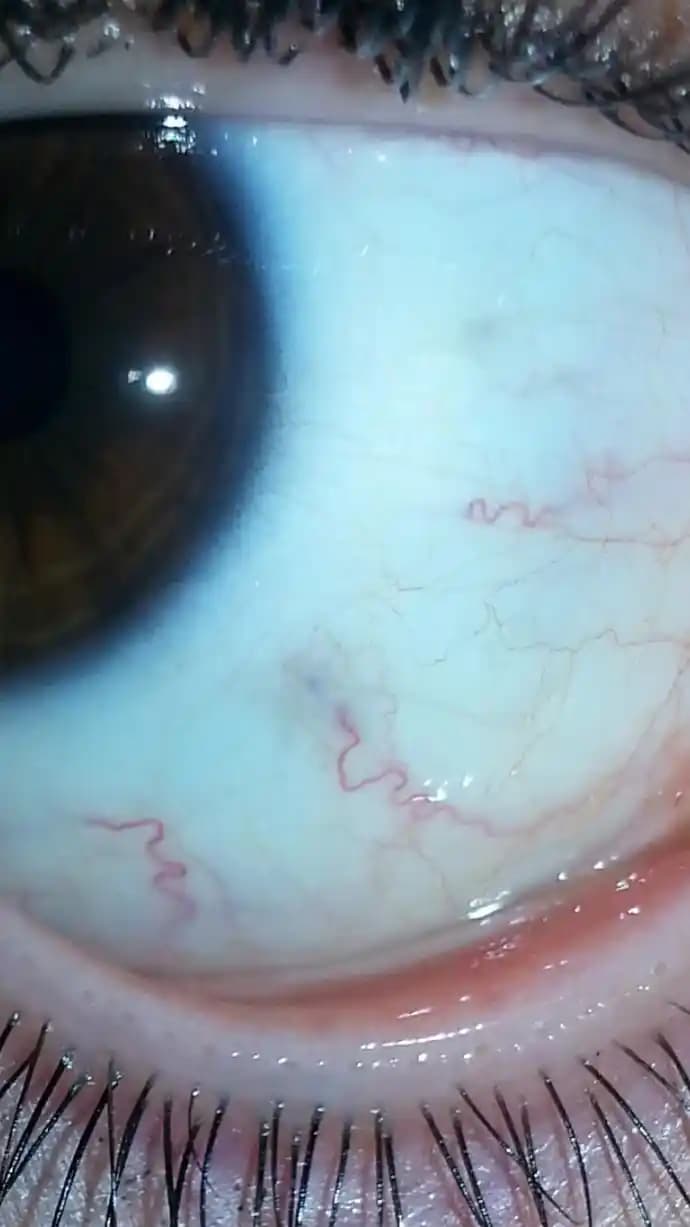 Göz İçindeki Mor Leke: Nedenleri, Sağlık ve Güzellik Açısından Alınacak Önlemler