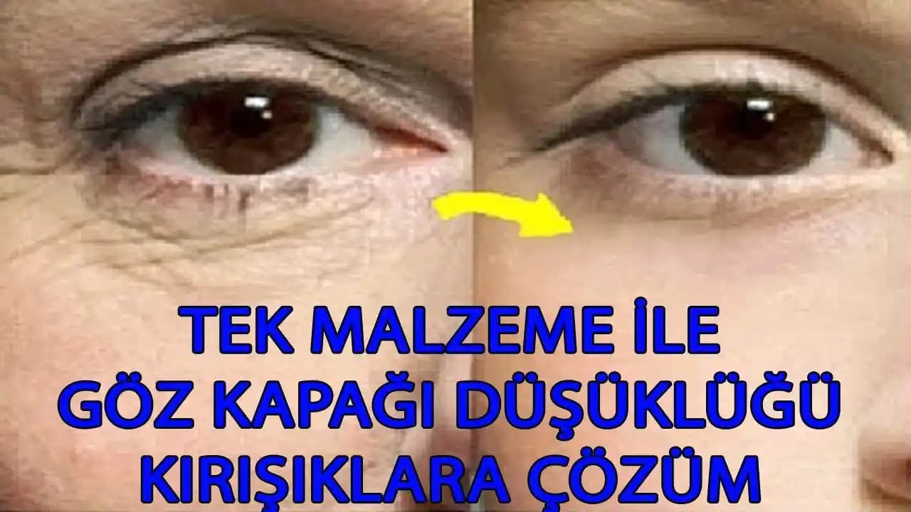 Göz Kapağı Kırışıklıklarıyla Mücadele Yöntemleri ve Güncel Yaklaşımlar