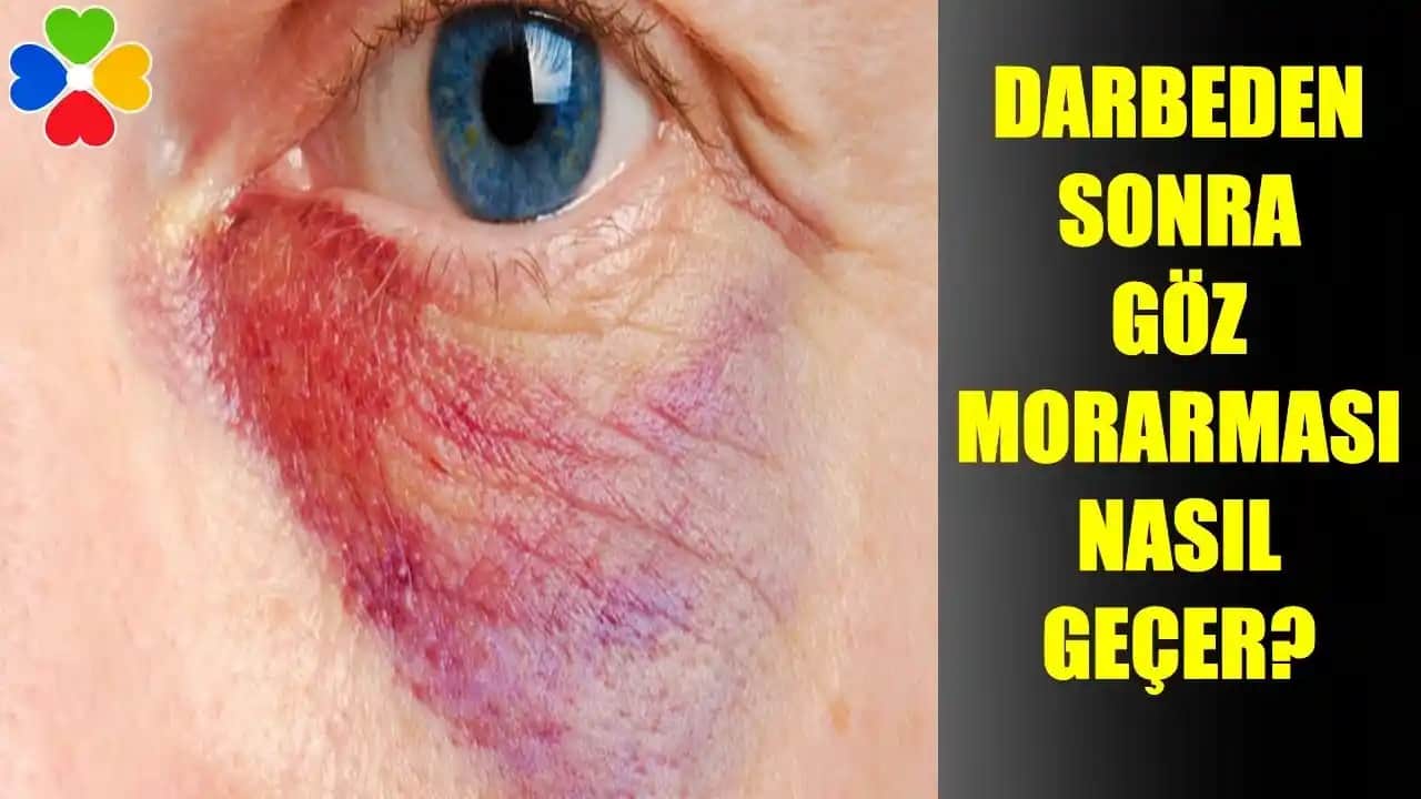 Göz Kapağı Morarmasının Nedenleri ve Alınabilecek Önlemler Hakkında Detaylı Bilgi