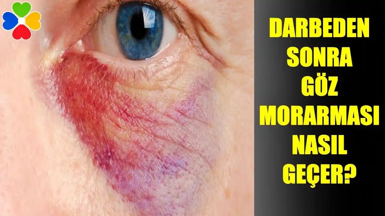 Göz Kapağı Morarmasının Nedenleri ve Alınabilecek Önlemler Hakkında Detaylı Bilgi