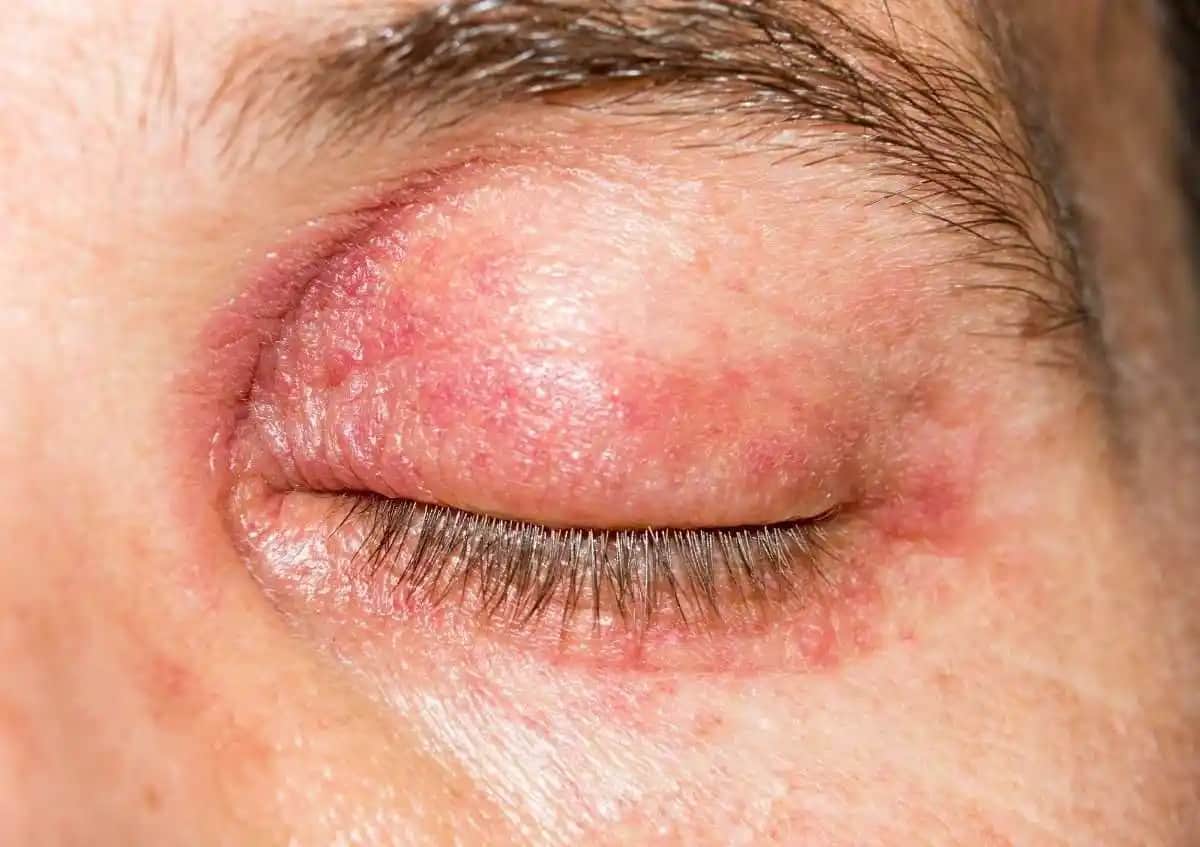 Göz Kapaklarında Kuruluk Nedenleri, Belirtileri ve Etkili Çözüm Yolları