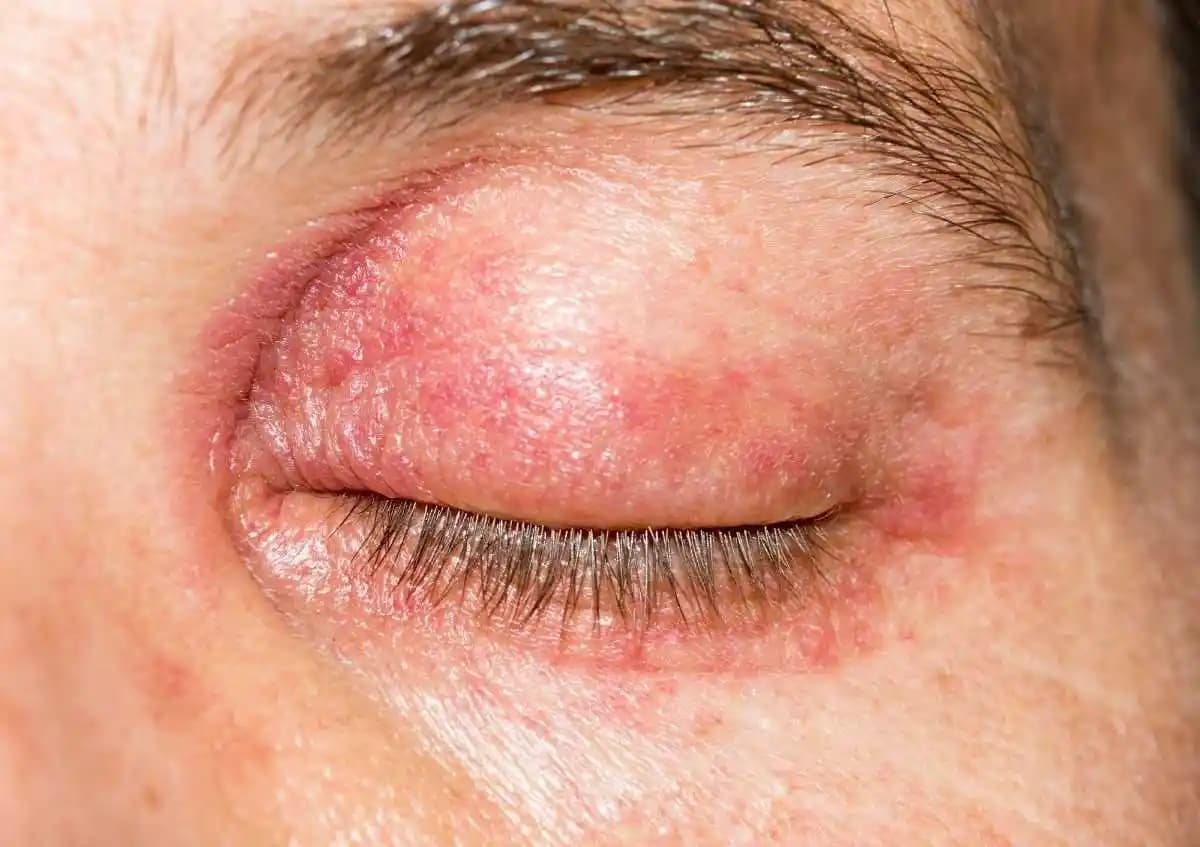 Göz Kapaklarında Kuruluk Nedenleri, Belirtileri ve Etkili Çözüm Yolları