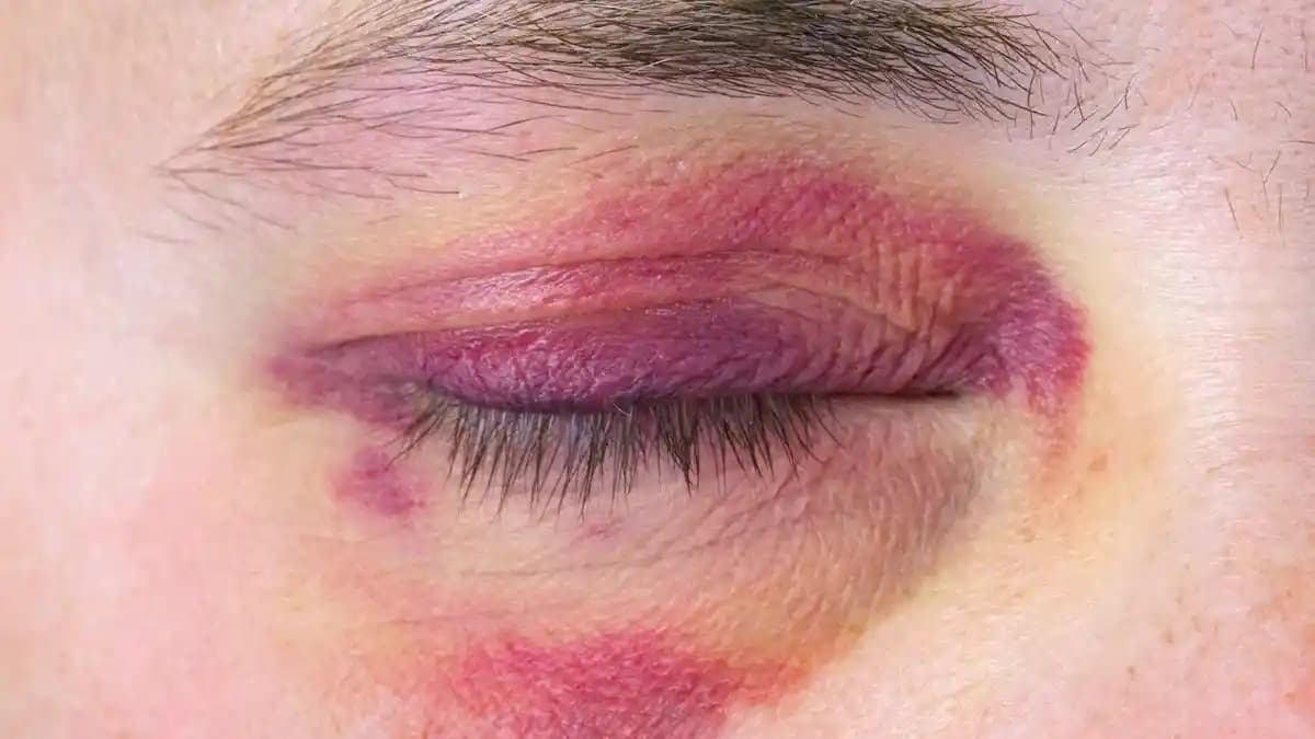 Göz Kapaklarındaki Morarmanın Nedenleri ve Etkili Çözüm Yöntemleri