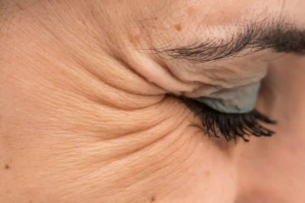 Göz Kazayağı Nedir, Neden Oluşur ve Göz Çevresi Estetiği Yöntemleri Nelerdir