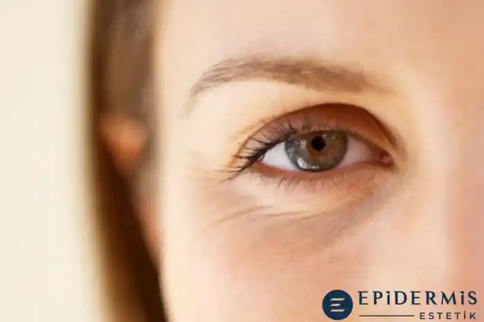 Göz Kenarı Kırışıklıkları Neden Oluşur ve Etkili Çözüm Yöntemleri Nelerdir