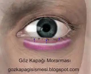 Göz Morarması Nasıl Geçer? Doğal ve Kozmetik Çözümlerle Göz Çevresi Bakımı