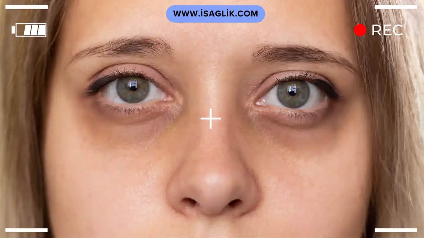 Göz Morluğu Nedenleri ve Kozmetik Çözüm Yöntemleri Hakkında Detaylı Bilgi