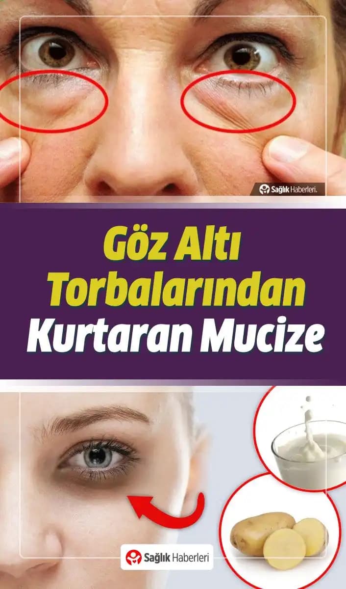 Göz Torbalarına Karşı Doğal ve Tıbbi Çözüm Yolları Hakkında Kapsamlı Rehber