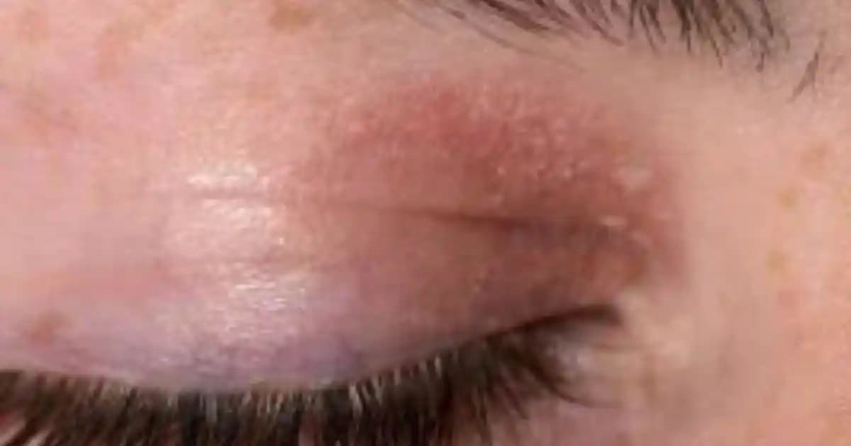 Göz Üstü Egzama Nedir, Belirtileri ve Etkili Tedavi Yöntemleri Hakkında Bilgiler