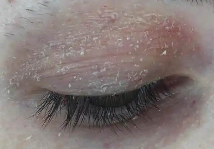 Gözde Egzama Nasıl Geçer: Nedenleri, Tedavi Yöntemleri ve Doğal Çözümler