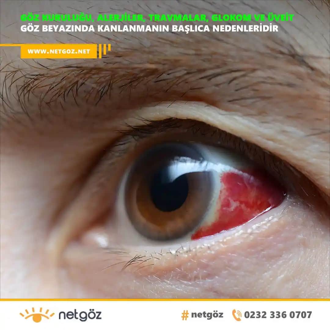 Gözdeki Kılcal Damarların Nedenleri ve Etkili Tedavi Yöntemleri