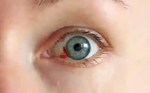 Gözdeki Kırmızı Leke Nedenleri ve Kozmetik Çözümler Hakkında Detaylı Bilgi