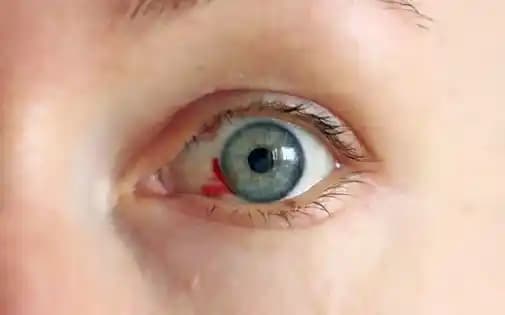 Gözdeki Kırmızı Leke Nedenleri ve Kozmetik Çözümler Hakkında Detaylı Bilgi