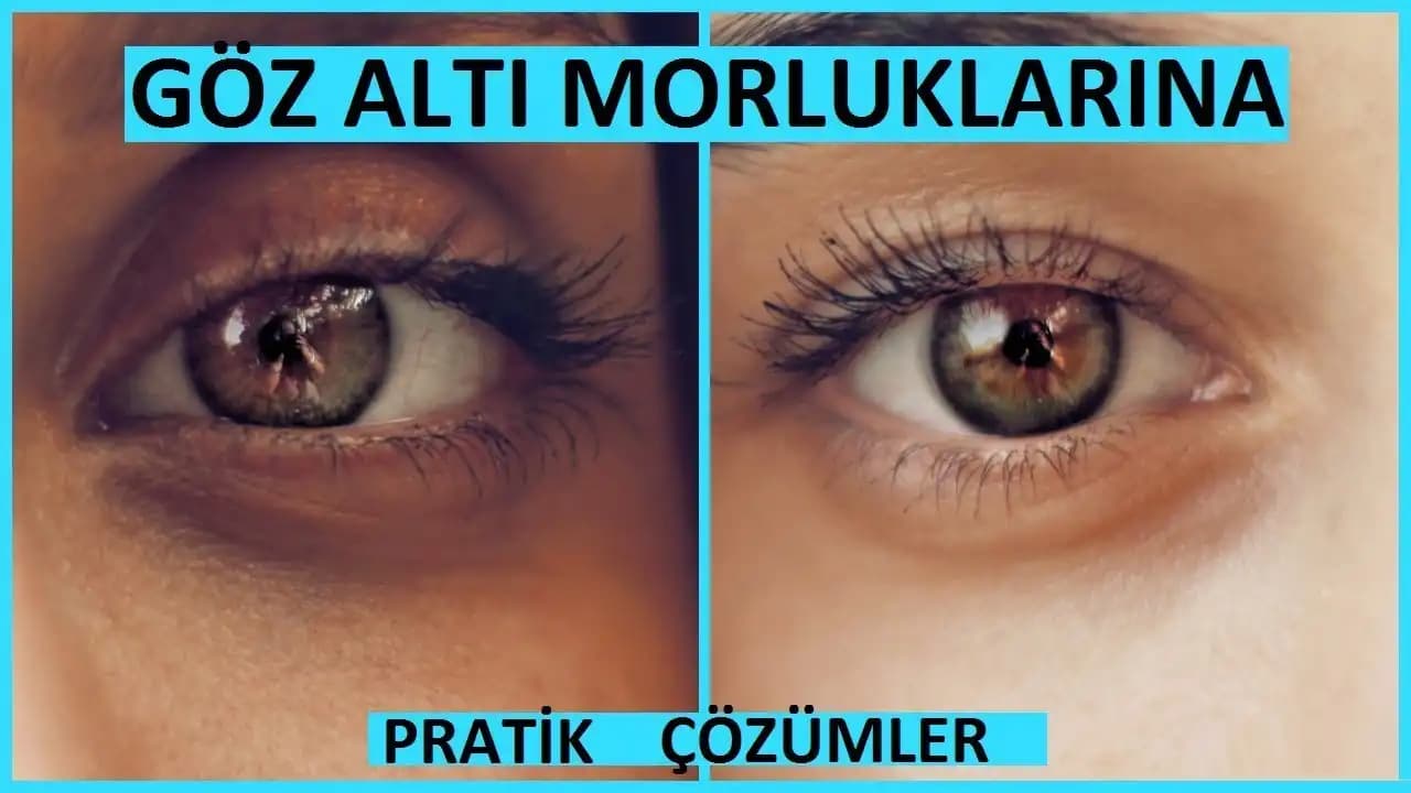 Gözdeki Morlukların Nedenleri ve Etkili Giderme Yöntemleri