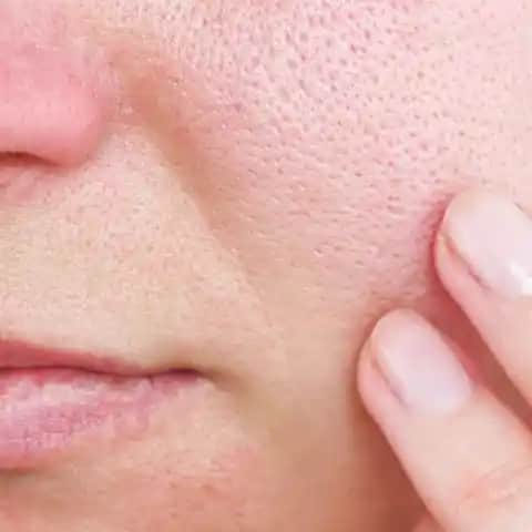 Gözenek Neden Açılır ve Genişlemesini Önlemenin Etkili Yolları