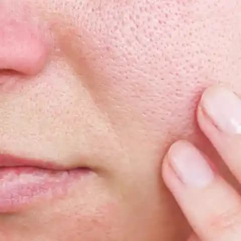 Gözenek Neden Açılır ve Genişlemesini Önlemenin Etkili Yolları