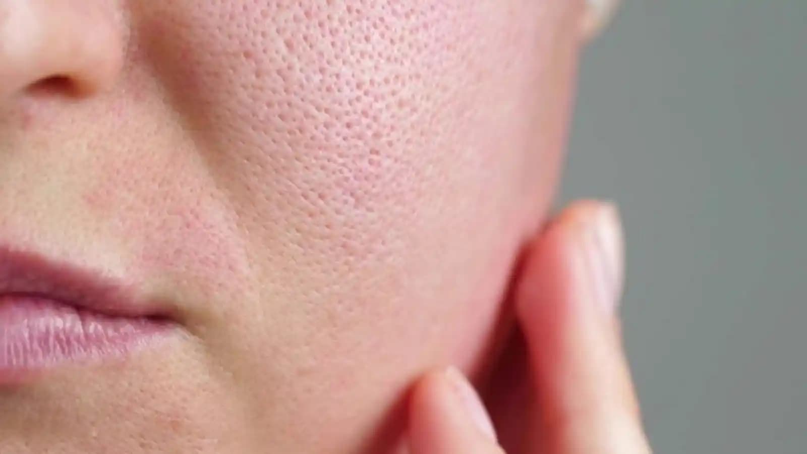 Gözenek Neden Büyür ve Nasıl Kontrol Altına Alınır Cilt Sağlığı İçin Bilimsel Yaklaşımlar