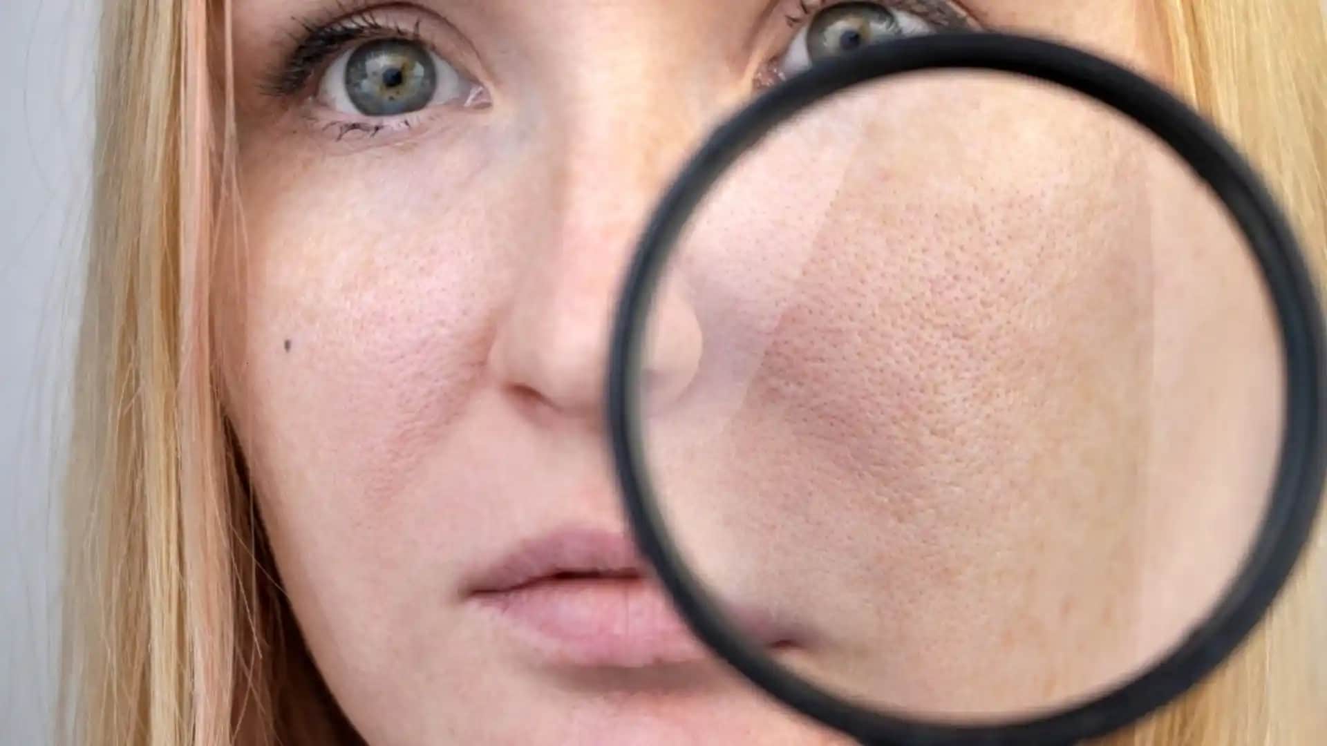 Gözenek Nedenleri ve Görünümünü Azaltma Yöntemleri Hakkında Detaylı Bilgi