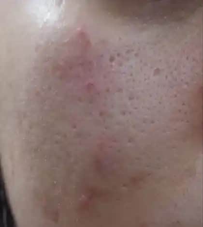 Gözenekleri Genişleten Faktörler ve Etkili Daraltma Yöntemleri