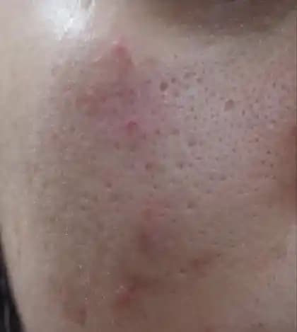 Gözenekleri Genişleten Faktörler ve Etkili Daraltma Yöntemleri