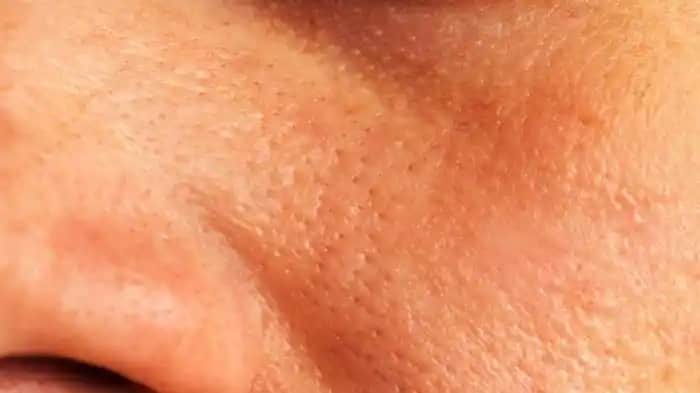 Gözenekleri Sıkılaştırma ve Yok Etme Yöntemleri: Etkili ve Güvenilir Çözümler