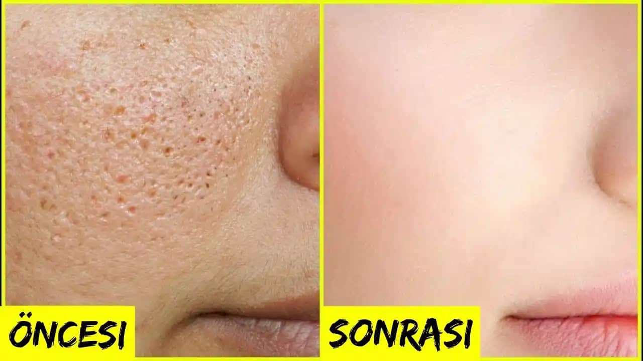 Gözenekleri Sıkılaştırma Yöntemleri ve Cilt Sağlığı İçin Pratik İpuçları