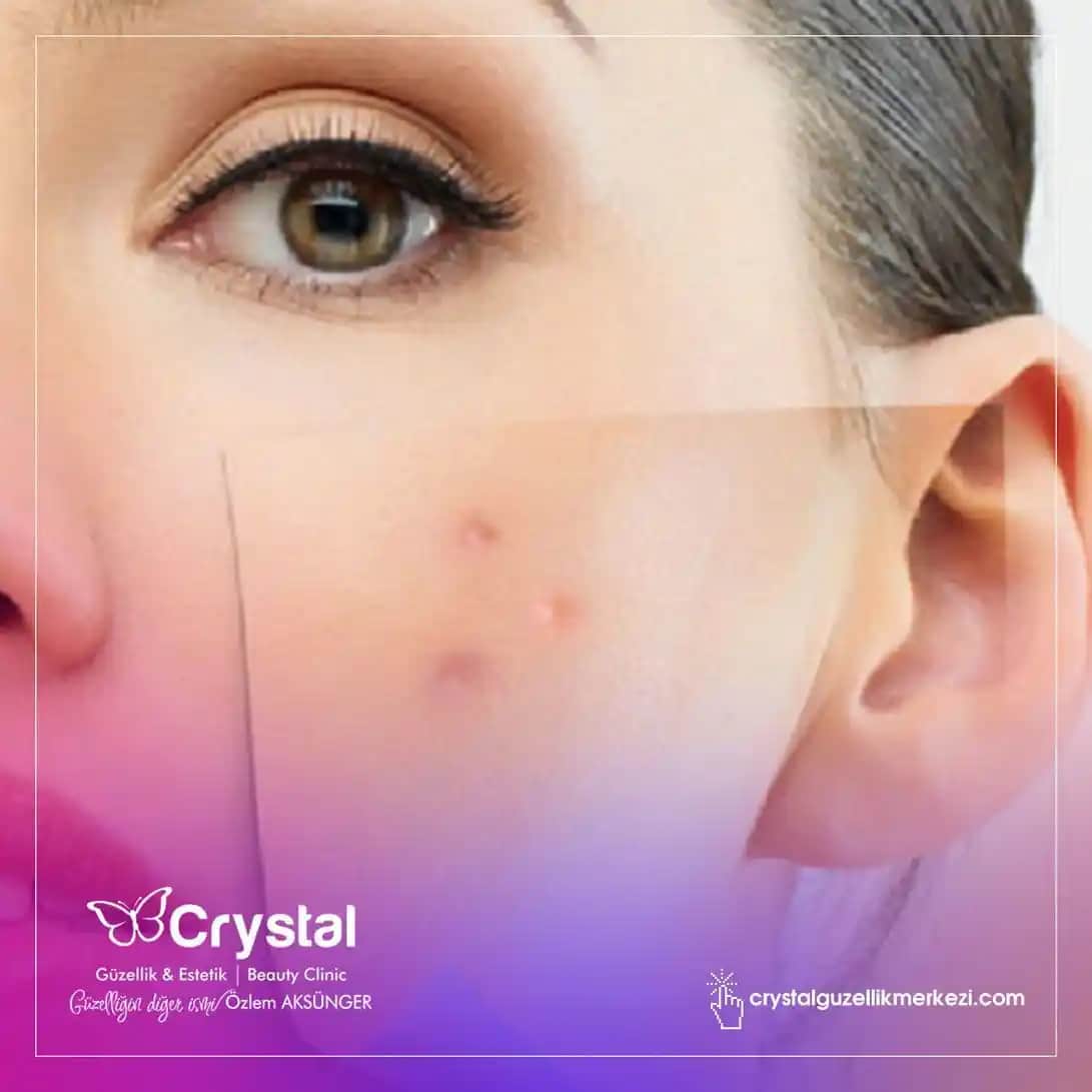 Gözeneklerin Tıkanma Nedenleri ve Cilt Sağlığını Koruma Yöntemleri