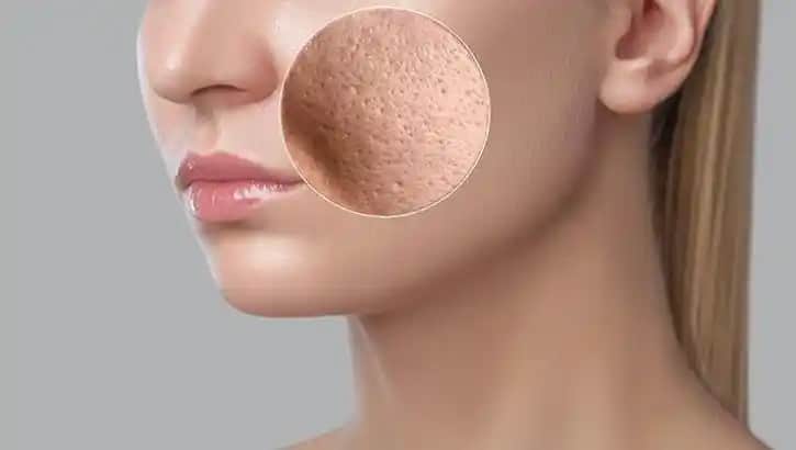 Gözenekli Cilt Nasıl Düzelir: Etkili Yöntemler ve Bakım İpuçları