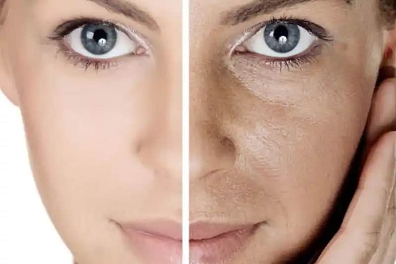 Gözenekli Cilt Tedavisi ve Görünümünü İyileştirmenin Modern Yöntemleri