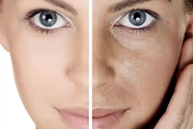 Gözenekli Cilt Tedavisi ve Görünümünü İyileştirmenin Modern Yöntemleri