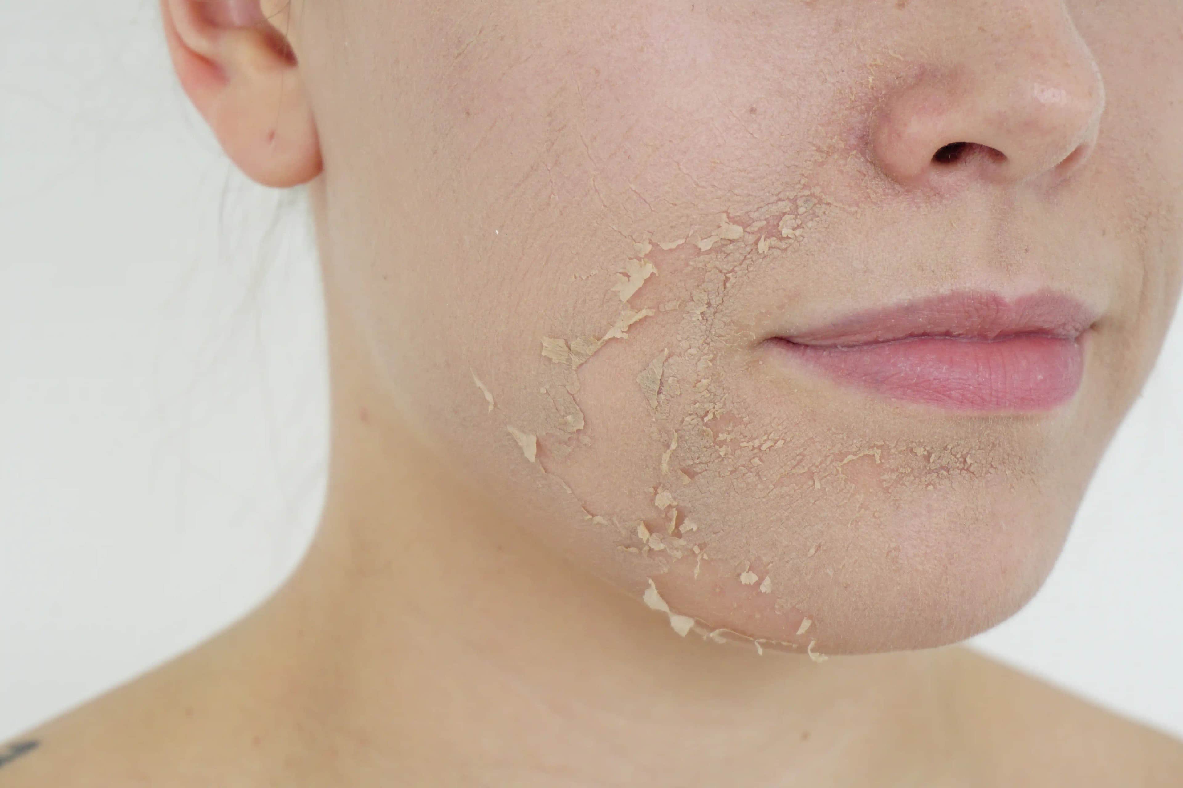 Green Peeling Nedir ve Cilt Yenilemede Doğal Bir Alternatif Olarak Avantajları