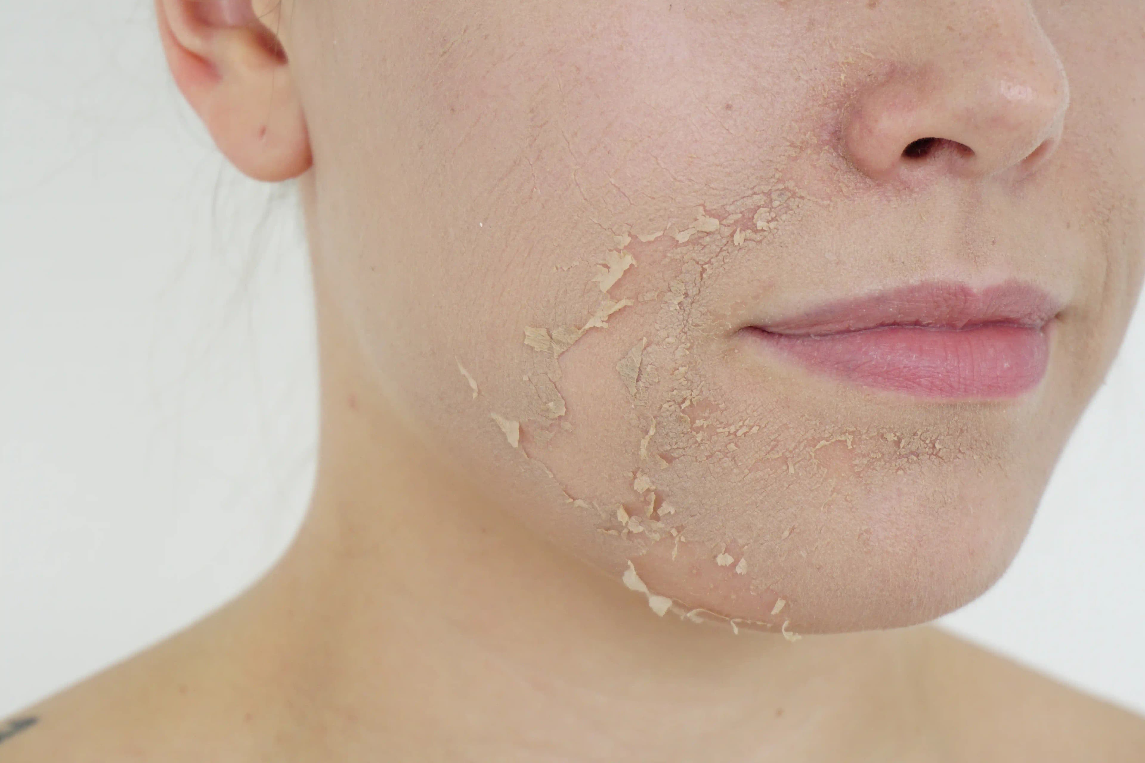 Green Peeling Nedir ve Cilt Yenilemede Doğal Bir Alternatif Olarak Avantajları