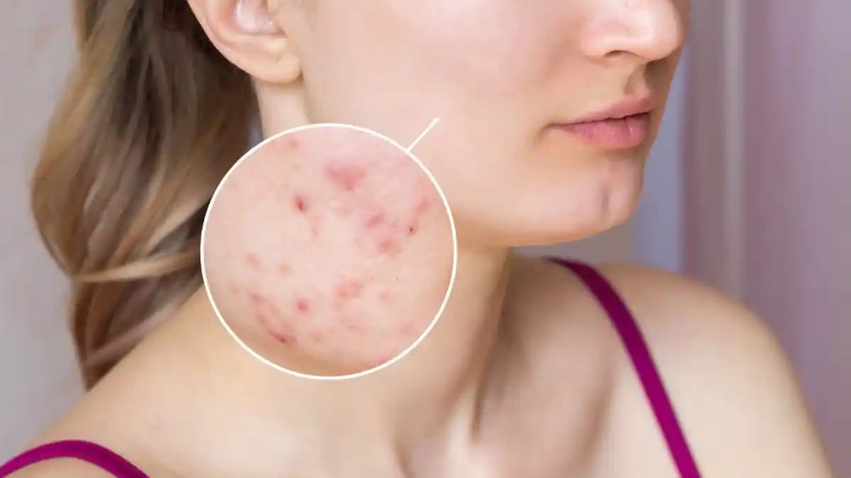 Gül Hastalığı Nedir, Belirtileri, Nedenleri ve Korunma Yöntemleri Hakkında Detaylı Bilgi