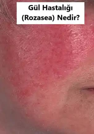 Gül Hastalığı Nedir, Tekrar Eder mi ve Kozmetik Bakımda Dikkat Edilmesi Gerekenler
