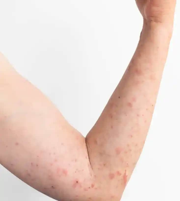 Gül Hastalığı ve Ciltteki Etkileri: Kozmetik Bakımda Dikkat Edilmesi Gerekenler