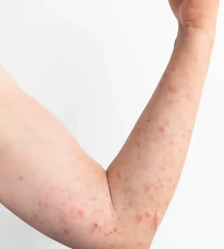 Gül Hastalığı ve Ciltteki Etkileri: Kozmetik Bakımda Dikkat Edilmesi Gerekenler