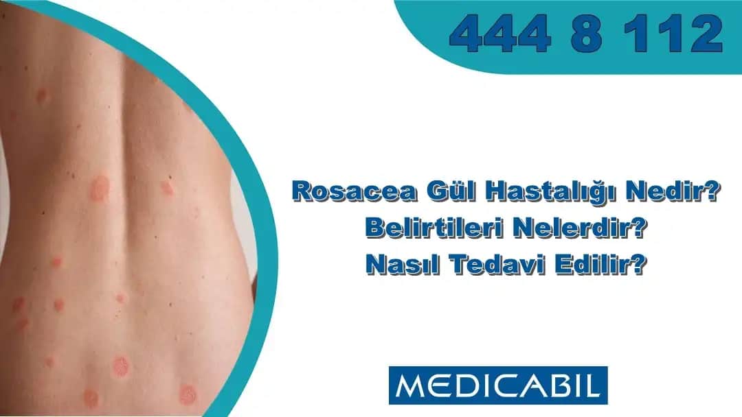 Gül Hastalığı ve Kozmetik Ürünlerde Gül İçeriğinin Rolü Cilt Sağlığını Anlamak