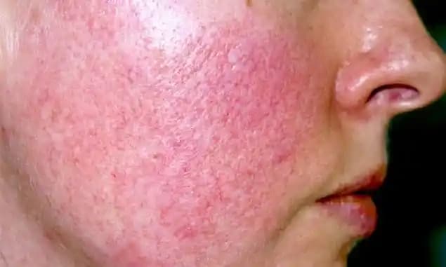 Gül Hastalığı ve Kozmetik Ürünlerde Güvenlik: Bilinçli Kullanım Rehberi