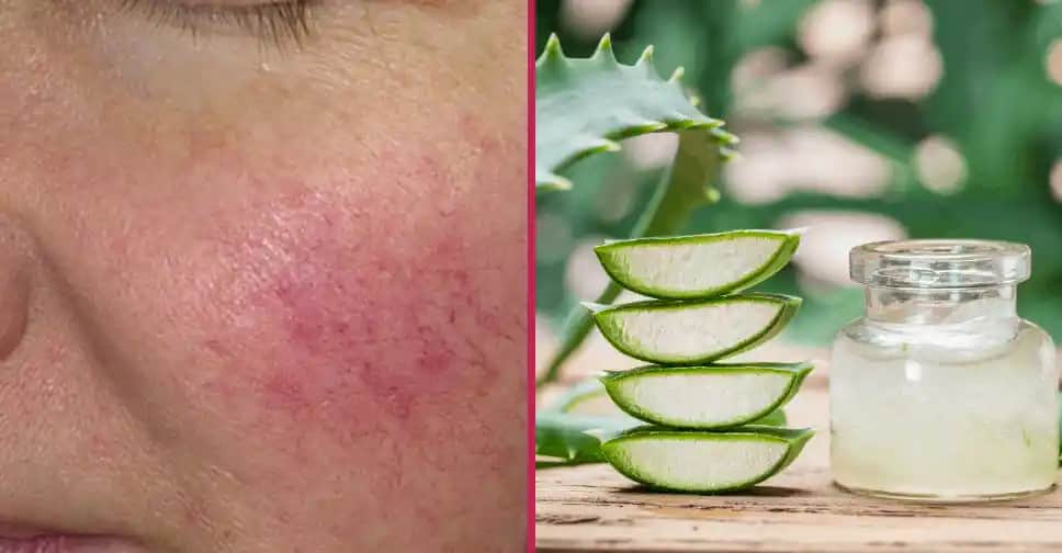 Gül Hastalığına Karşı Doğal Yağlar ve Cilt Bakım Rehberi